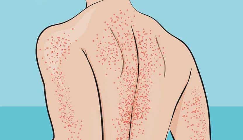 طرق علاج نقص الصفائح الدموية