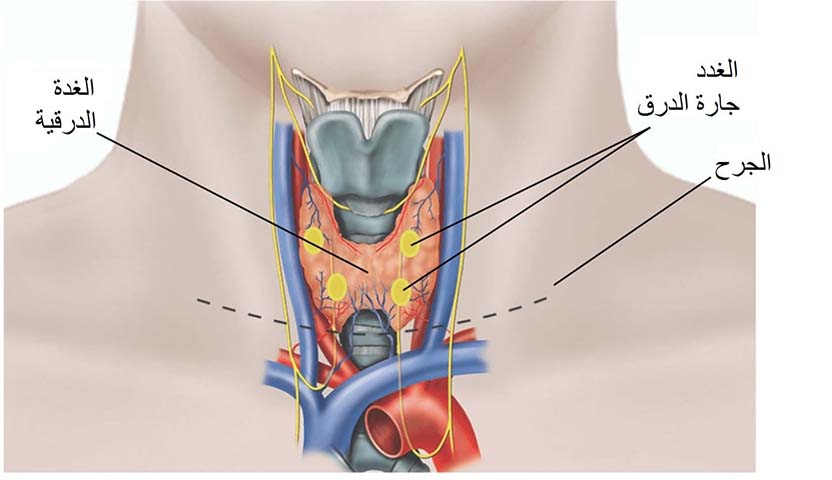 استئصال الغدة الدرقية