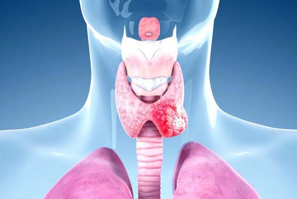 انواع سرطان الغدة الدرقية