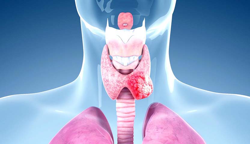 انواع سرطان الغدة الدرقية