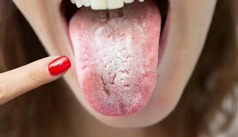 NBCC - فطريات الفم سرطان اللسان