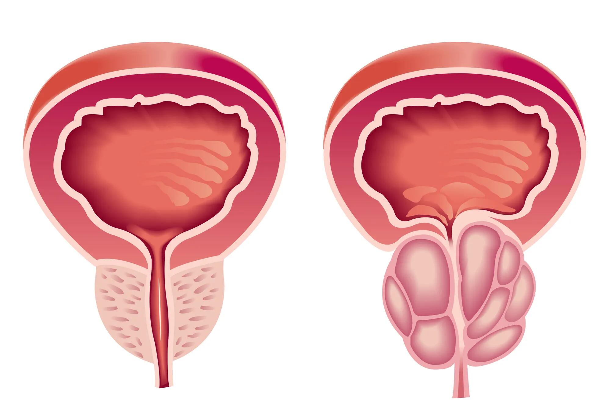 NBCC - سرطان البروستاتا | الأعراض والأسباب والعلاج
