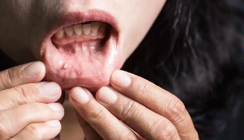 NBCC - نسبة الشفاء من سرطان الفم