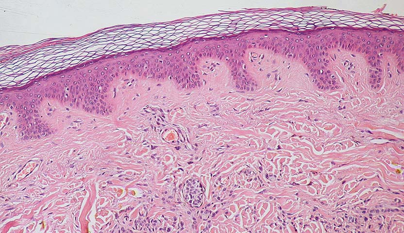 أعراض الورم الحميد في الغدة الدرقية