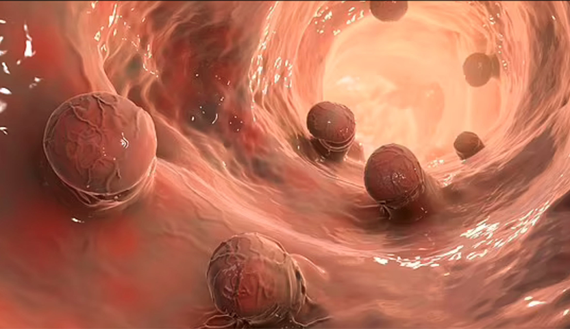 أعراض سرطان القولون في مراحله الأخيرة