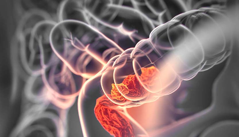 أنواع سلائل القولون