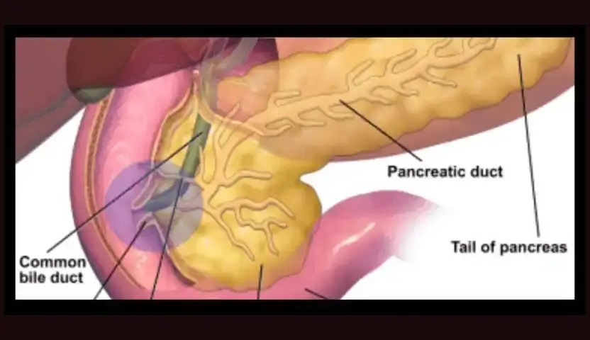 اسباب السرطان الأمبولي