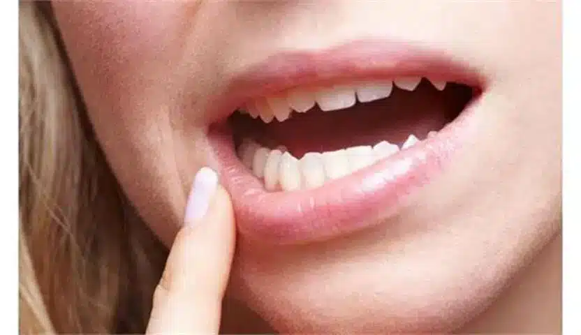 اعراض سرطان الفم