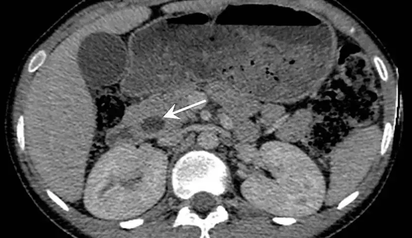 تشخيص السرطان الأمبولي