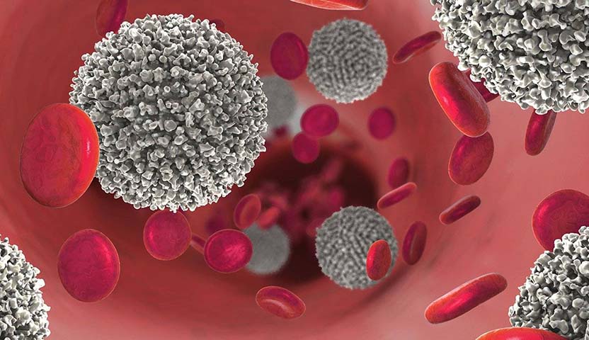 سرطان الدم النخاعي المزمن