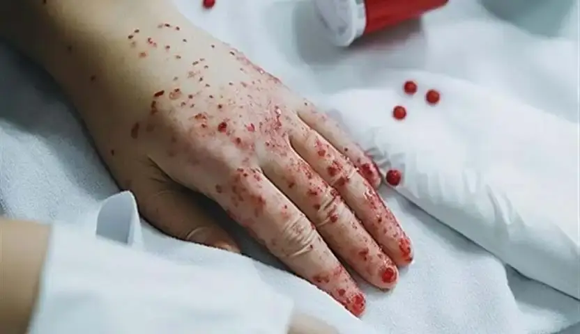 سرطان الدم عند النساء