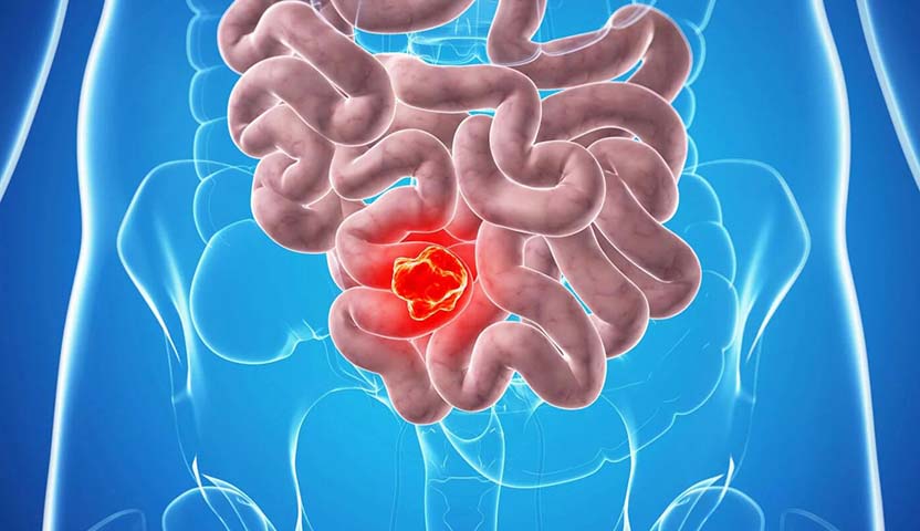 سرطان القولون والمستقيم