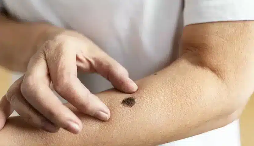 علاج سرطان الخلايا الحرشفية