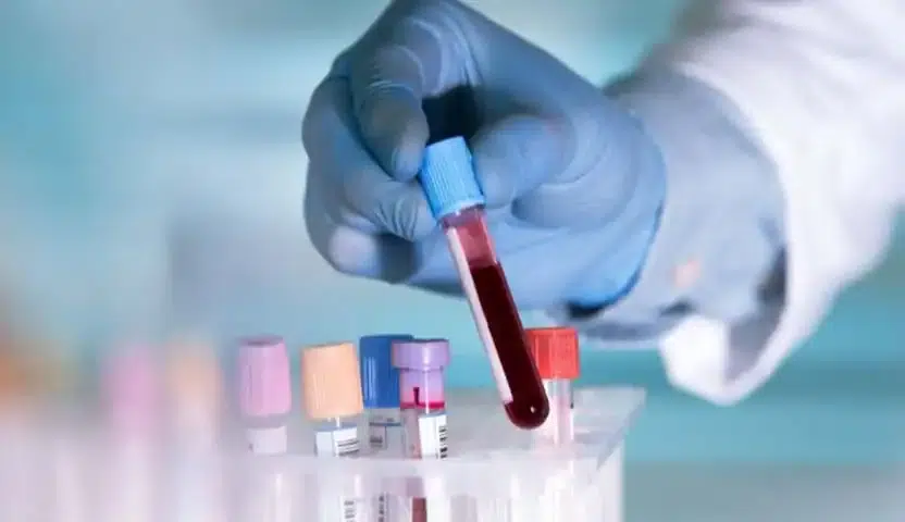 علاج سرطان الدم النقوي المزمن