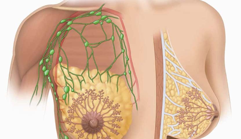 عوامل اختيار علاج سرطان الغدد الليمفاوية