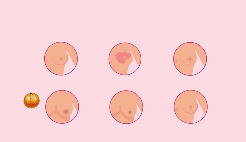 كيف يتم فحص سرطان الثدي في المنزل؟ 