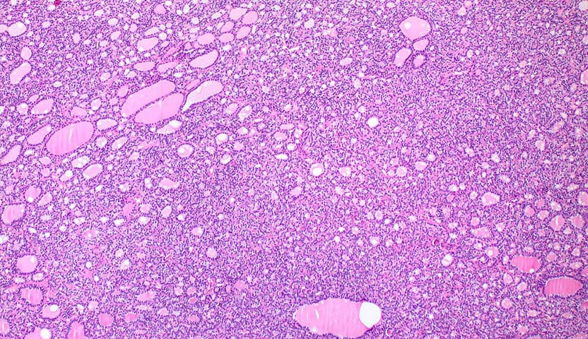 ما هو سرطان الغدة الدرقية الجريبي