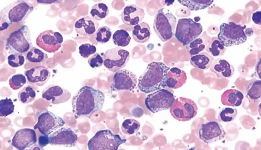 مراحل سرطان الدم النقوي المزمن