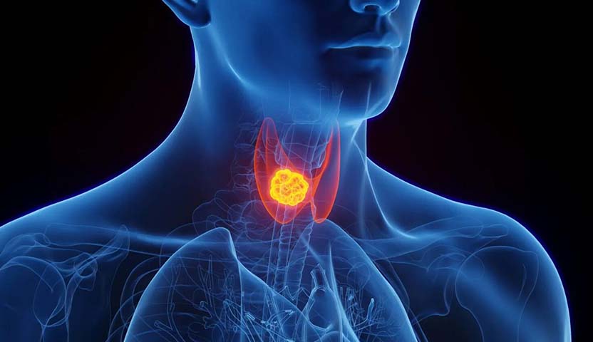 نسبة الشفاء من سرطان الغدة الدرقية الحليمي