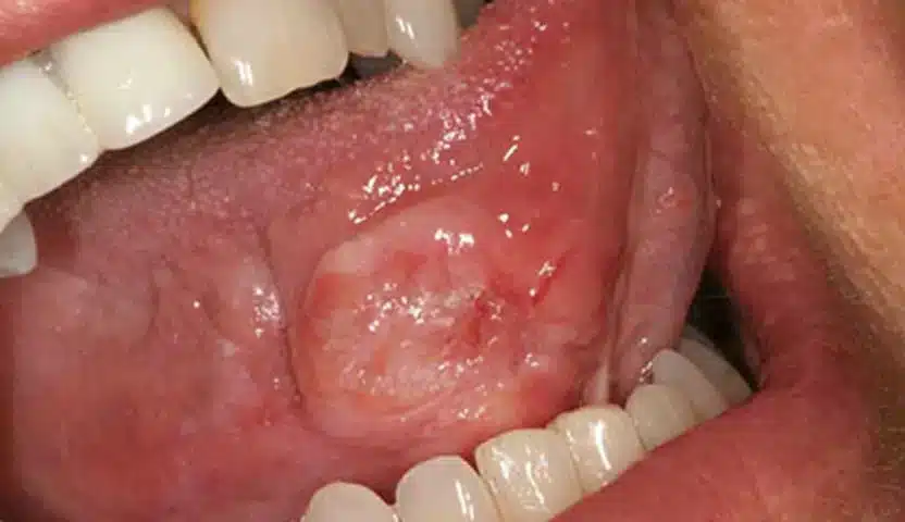 أعراض سرطان الفم والحلق