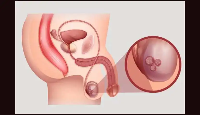 أعراض سرطان الخصية