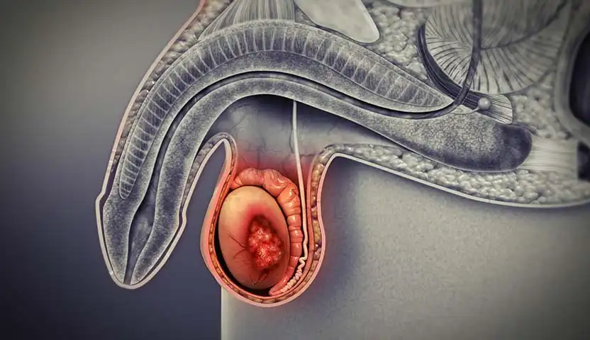 أنواع سرطان الخصية