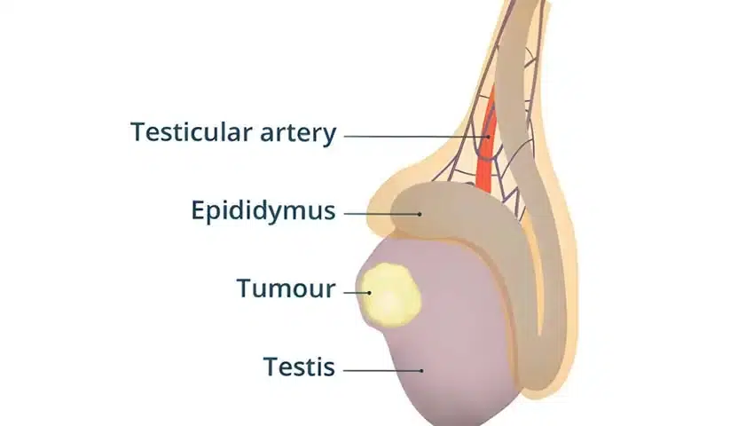 أنواع سرطان الخصية