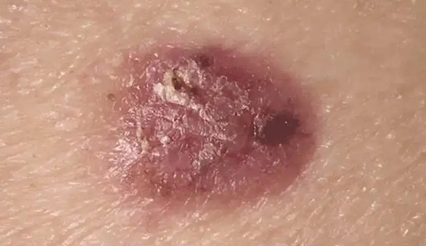 أنواع سرطان الخلايا القاعدية الحميد