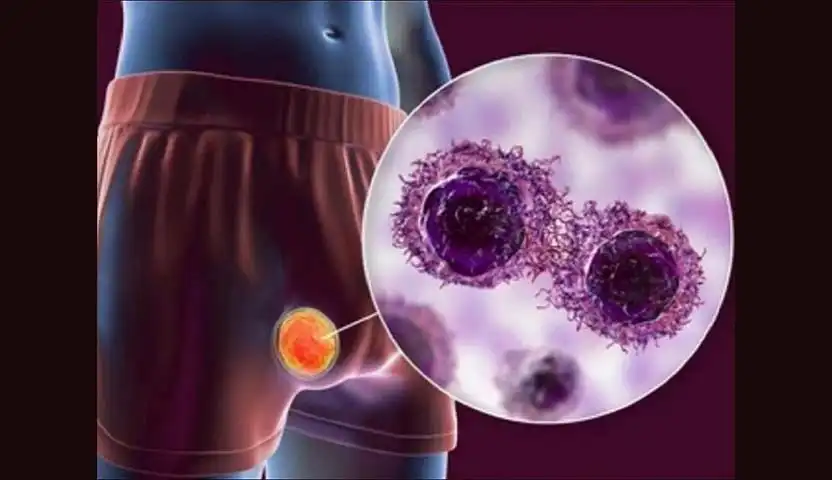 اعراض سرطان الخصية