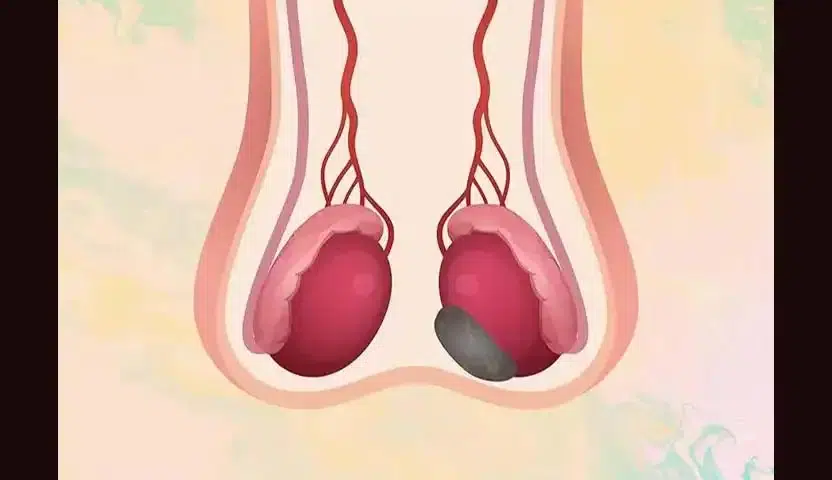 التعافي من سرطان الخصية