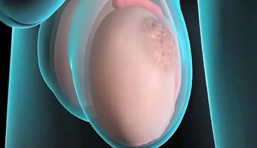 الفرق بين ورم الخصية الحميد والخبيث