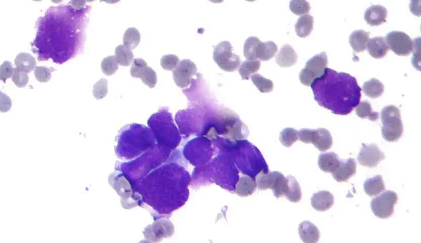 شكل سرطان الخلايا القاعدية العقدية