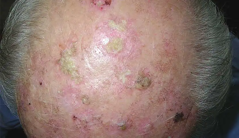 علاج سرطان الخلايا القاعدية العقدية