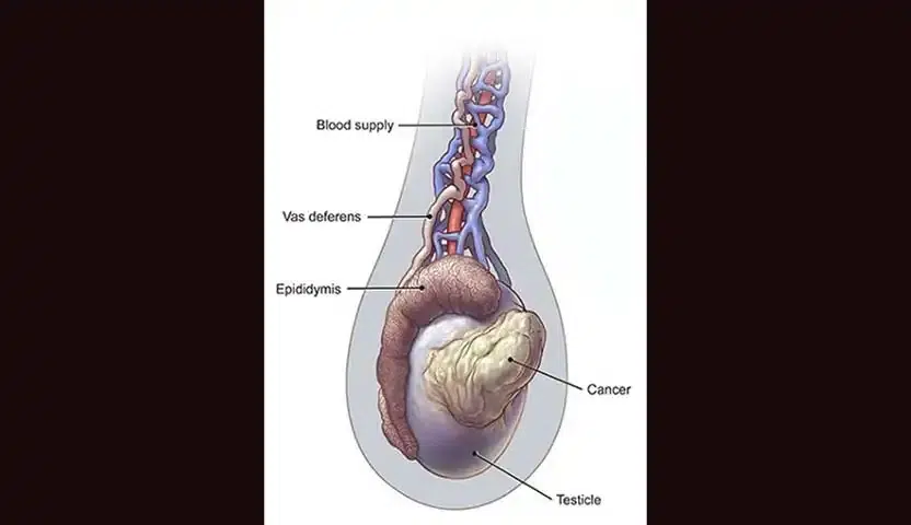 تشخيص سرطان الخصية
