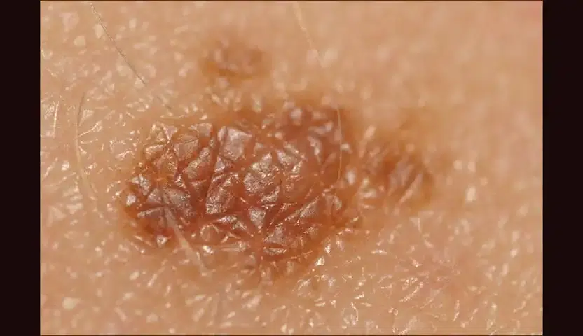 كيفية الوقاية من سرطان الخلايا القاعدية