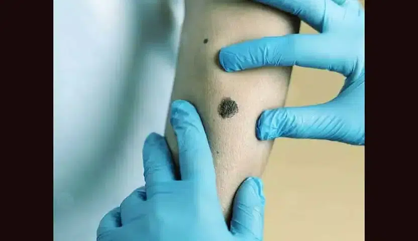 هل سرطان الخلايا القاعدية قاتل